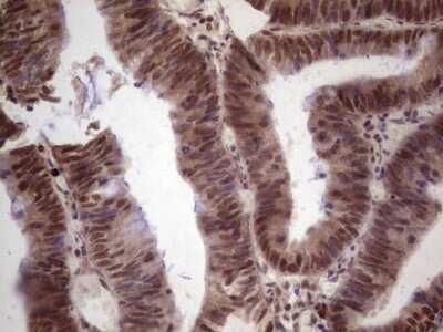 Immunohistochemistry: GLI4 Antibody (OTI3A9) [NBP2-45874] - GLI4 Antibody (3A9) [NBP2-45874] - Analysis of Adenocarcinoma of Human colon tissue. (Heat-induced epitope retrieval by 1 mM EDTA in 10mM Tris, pH8.5, 120C for 3min)