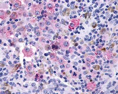 Immunohistochemistry-Paraffin: GLP-2R Antibody [NLS1315] - Analysis of anti-GLP2R / Glp-2 antibody with human skin, melanoma.