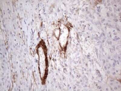 Immunohistochemistry: GM-CSF Antibody (8G5) [NBP2-46364] - Analysis of Carcinoma of Human liver tissue.(Heat-induced epitope retrieval by 1mM EDTA in 10mM Tris buffer (pH8.5) at 120C for 3 min)