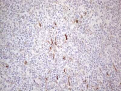 Immunohistochemistry: GM-CSF Antibody (8G5) [NBP2-46364] - Analysis of Human lymphoma tissue. (Heat-induced epitope retrieval by 1mM EDTA in 10mM Tris buffer (pH8.5) at 120C for 3 min)