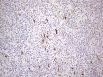 Immunohistochemistry: GM-CSF Antibody (OTI8G5) - Azide and BSA Free [NBP2-70462] - Analysis of Human lymphoma tissue. (Heat-induced epitope retrieval by 1mM EDTA in 10mM Tris buffer (pH8.5) at 120C for 3 min)