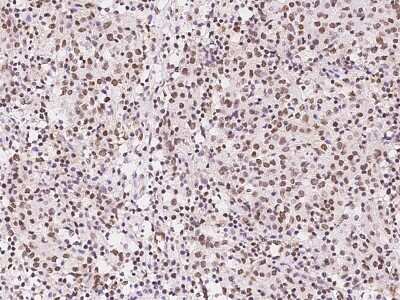 Immunohistochemistry-Paraffin: GMEB1 Antibody [NBP2-99588] - Immunochemical staining of human GMEB1 in human lung cancer with rabbit polyclonal antibody at 1:1000 dilution, formalin-fixed paraffin embedded sections.
