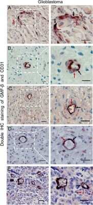 Immunocytochemistry/Immunofluorescence: GMF-beta Antibody [NBP1-89755] - GMF-beta is involved in neovasculogenesis in human glioblastoma. A. Co-expression of GMF-beta and CD31 in several tumor cells. B. The GMF-beta+/CD31+ incomplete microvessel-like structure in hypovascular zones. C. GMF-beta+/CD31+ immature microvessel in hypovascular zones. D. Single GMF-beta+/CD31+ mature microvessel in vascularized areas. E. GMF-beta-/CD31+ mature microvessels in vascularized areas. Red arrows denote GMF-beta staining, black arrows indicate CD31 staining. Scale bar: 50 um. Image collected and cropped by CiteAb from the following publication (//www.oncotarget.com/abstract/5509), licensed under a CC-BY license.