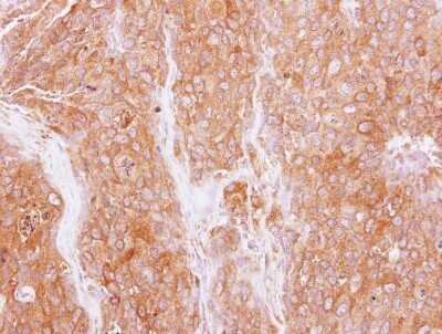 Immunohistochemistry-Paraffin: GMF-beta Antibody [NBP2-43647] - Analysis of BT474 xenograft, using GMF beta antibody at 1:500 dilution.