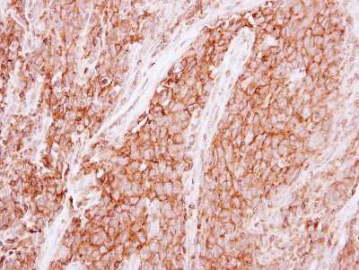 Immunohistochemistry-Paraffin: GNB1 Antibody [NBP2-16699] - Human lung papillory adenocarcinoma, using GNB1antibody at 1:500 dilution. Antigen Retrieval: Trilogy™ (EDTA based, pH 8.0) buffer, 15min