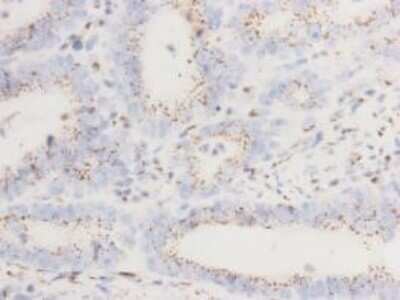 Immunohistochemistry-Paraffin: GOLGA5 Antibody (11-D7) [NBP2-66875] - Analysis of paraffin- embedded gastric cancer tissue using anti-GOLGA5 Mouse mAb.