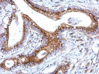 Immunohistochemistry-Paraffin: GOLM1 Antibody [NBP2-16706] - Analysis of paraffin-embedded Gastric ca, using antibody at 1:500 dilution.