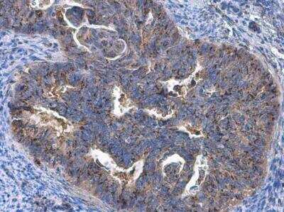 Immunohistochemistry-Paraffin: GOLM1 Antibody [NBP2-16706] - GOLM1 antibody detects GOLM1 protein at Golgi apparatus by immunohistochemical analysis. Sample: Paraffin-embedded human endometrial carcinoma. GOLM1 stained by GOLM1 antibody diluted at 1:10000.