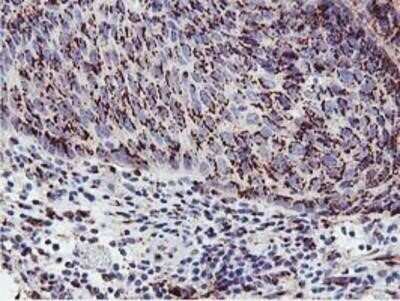 Immunohistochemistry: GOLM1 Antibody (OTI4B12) - Azide and BSA Free [NBP2-71916] - Staining of paraffin-embedded Carcinoma of Human bladder tissue using anti-GOLM1 mouse monoclonal antibody.