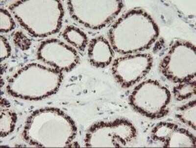 Immunohistochemistry: GOLM1 Antibody (OTI4B12) - Azide and BSA Free [NBP2-71916] - Staining of paraffin-embedded Carcinoma of Human thyroid tissue using anti-GOLM1 mouse monoclonal antibody.