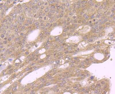 Immunohistochemistry-Paraffin: GOLPH3 Antibody [NBP2-75515] - Analysis of paraffin-embedded human stomach cancer tissue using anti-GOLPH3 antibody. Counter stained with hematoxylin.