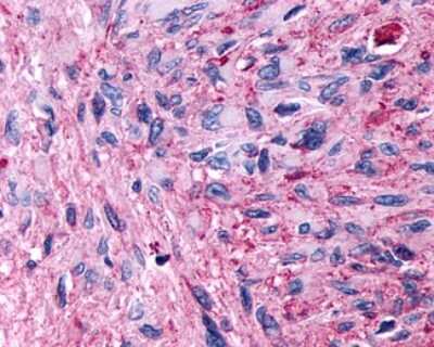 Immunohistochemistry-Paraffin: GPCR GPR89 Antibody [NLS1734] - Analysis of anti-GPR89A antibody with human brain, glioblastoma.