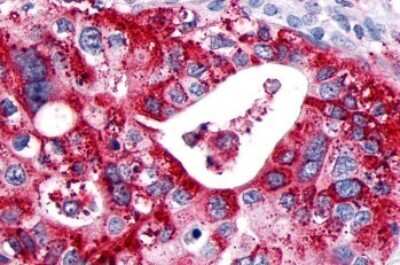 Immunohistochemistry-Paraffin: GPCR GPR89 Antibody [NLS1734] - Anti-GPR89A antibody IHC of human Pancreas, Carcinoma. Immunohistochemistry of formalin-fixed, paraffin-embedded tissue after heat-induced antigen retrieval.