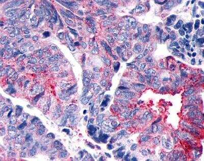 Immunohistochemistry-Paraffin: GPER/GPR30 Antibody [NLS1184] - Anti-GPER1 / GPR30 antibody IHC of human Colon, Carcinoma. Immunohistochemistry of formalin-fixed, paraffin-embedded tissue after heat-induced antigen retrieval.