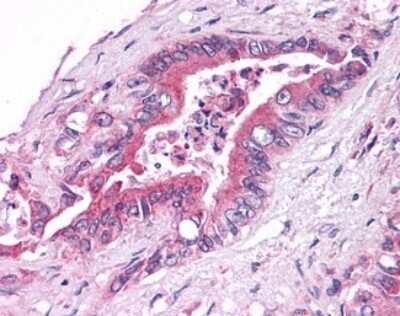 Immunohistochemistry-Paraffin: GPER/GPR30 Antibody [NLS4272] - Analysis of anti-GPER1 / GPR30 antibody with human pancreas, carcinoma.