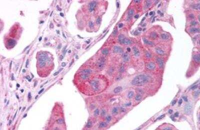 Immunohistochemistry-Paraffin: GPER/GPR30 Antibody [NLS4272] - Breast, adenocarcinoma