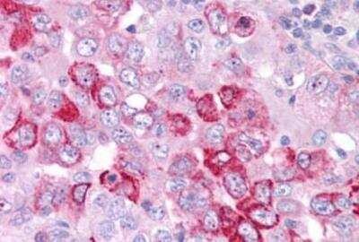 Immunohistochemistry-Paraffin: GPER/GPR30 Antibody [NLS4272] - Lung, non small cell carcinoma