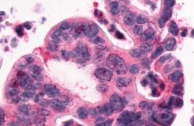 Immunohistochemistry-Paraffin: GPR1 Antibody [NLS77] - Anti-GPR1 antibody IHC of human Pancreas, Carcinoma. Immunohistochemistry of formalin-fixed, paraffin-embedded tissue after heat-induced antigen retrieval.