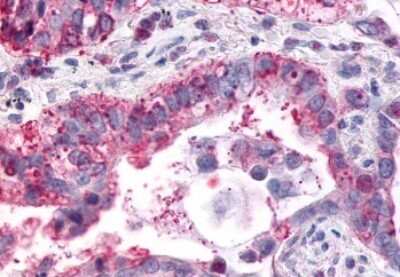 Immunohistochemistry-Paraffin: GPR1 Antibody [NLS77] - Anti-GPR1 antibody IHC of human Lung, Adenocarcinoma. Immunohistochemistry of formalin-fixed, paraffin-embedded tissue after heat-induced antigen retrieval.