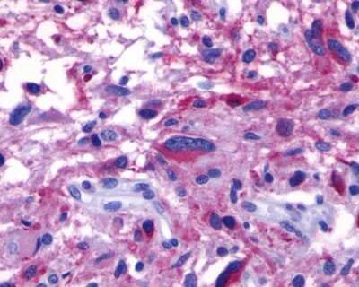 Immunohistochemistry-Paraffin: GPR110 Antibody [NLS2019] - Analysis of anti-GPR110 antibody with human brain, glioblastoma.