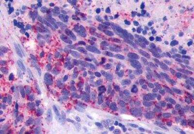 Immunohistochemistry-Paraffin: GPR110 Antibody [NLS2019] -  Human Lung, Small Cell Carcinoma tissue after heat-induced antigen retrieval.