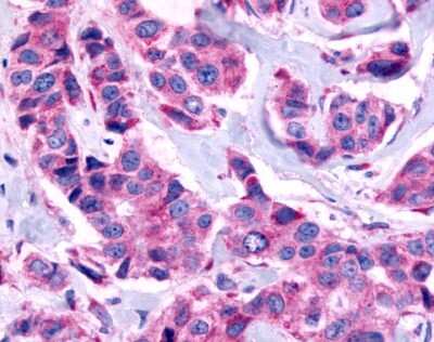 Immunohistochemistry-Paraffin: GPR115 Antibody [NLS2723] - Analysis of anti-GPR115 antibody with human breast, carcinoma.