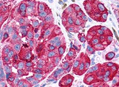 Immunohistochemistry-Paraffin: GPR116 Antibody [NLS1519] - Human Skin, Melanoma Formalin-fixed, paraffin-embedded tissue after heat-induced antigen retrieval.