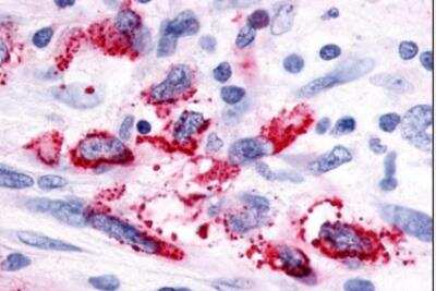 Immunohistochemistry-Paraffin: GPR116 Antibody [NLS1519] - Human Brain, Glioblastoma. Formalin-fixed, paraffin-embedded tissue after heat-induced antigen retrieval.