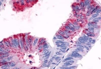 Immunohistochemistry-Paraffin: GPR119 Antibody [NBP3-14344] - Immunohistochemistry of formalin-fixed, paraffin-embedded human colon carcinoma after heat-induced antigen retrieval.