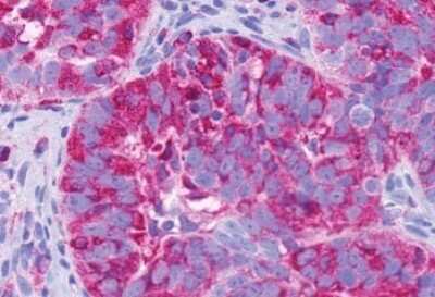 Immunohistochemistry-Paraffin: GPR137B Antibody [NLS793] - Anti-GPR137B antibody IHC of human Ovary, Carcinoma. Immunohistochemistry of formalin-fixed, paraffin-embedded tissue after heat-induced antigen retrieval.