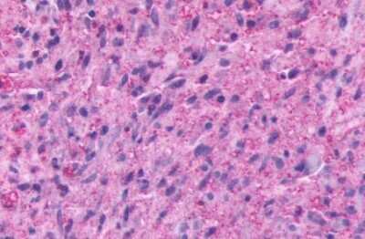 Immunohistochemistry-Paraffin: GPR137B Antibody [NLS793] - Anti-GPR137B antibody IHC of human Brain, Glioblastoma. Immunohistochemistry of formalin-fixed, paraffin-embedded tissue after heat-induced antigen retrieval.
