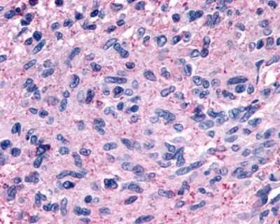 Immunohistochemistry-Paraffin: GPR139 Antibody [NLS2717] - Analysis of anti-GPR139 antibody with human brain, glioblastoma.