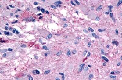 Immunohistochemistry-Paraffin: GPR139 Antibody [NLS2719] - Anti-GPR139 antibody IHC of human Brain, Glioblastoma. Immunohistochemistry of formalin-fixed, paraffin-embedded tissue after heat-induced antigen retrieval.