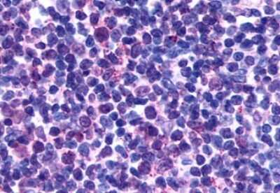 Immunohistochemistry-Paraffin: GPR146 Antibody [NLS1988] - Anti-GPR146 antibody IHC of human Lymph Node, Non-Hodgkins Lymphoma. Immunohistochemistry of formalin-fixed, paraffin-embedded tissue after heat-induced antigen retrieval.