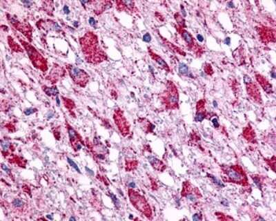 Immunohistochemistry-Paraffin: GPR15 Antibody [NLS1613] - Analysis of anti-BOB / GPR15 antibody with human brain, glioblastoma.