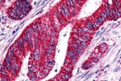 Immunohistochemistry-Paraffin: GPR15 Antibody [NLS1613] - Anti-BOB / GPR15 antibody IHC of human Colon, Carcinoma. Immunohistochemistry of formalin-fixed, paraffin-embedded tissue after heat-induced antigen retrieval.