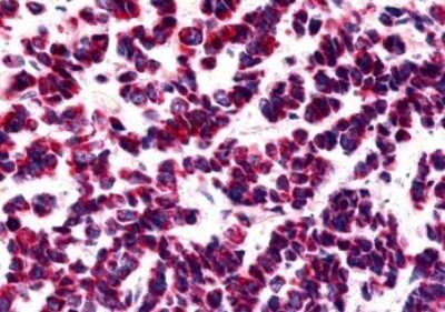 Immunohistochemistry-Paraffin: GPR15 Antibody [NLS1613] - Anti-BOB / GPR15 antibody IHC of human Lung, Small Cell Carcinoma. Immunohistochemistry of formalin-fixed, paraffin-embedded tissue after heat-induced antigen retrieval.