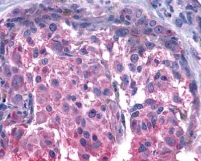 Immunohistochemistry-Paraffin: GPR15 Antibody [NLS6285] - Analysis of anti-GPR15 antibody with human skin, melanoma.