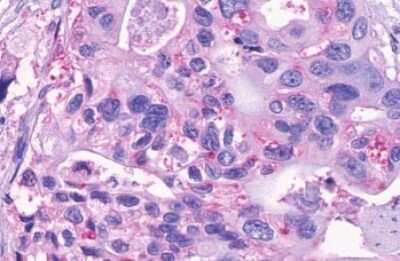 Immunohistochemistry-Paraffin: GPR150 Antibody [NLS3345] - Anti-GPR150 antibody IHC of human Pancreas, Carcinoma. Immunohistochemistry of formalin-fixed, paraffin-embedded tissue after heat-induced antigen retrieval.
