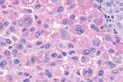 Immunohistochemistry-Paraffin: GPR150 Antibody [NLS3345] - Anti-GPR150 antibody IHC of human Skin, Melanoma. Immunohistochemistry of formalin-fixed, paraffin-embedded tissue after heat-induced antigen retrieval.