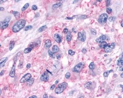 Immunohistochemistry-Paraffin: GPR161 Antibody [NLS331] - Analysis of anti-GPR161 antibody with human brain, glioblastoma.