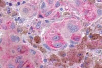 Immunohistochemistry-Paraffin: GPR161 Antibody [NLS331] - Anti-GPR161 antibody IHC of human Skin, Melanoma. Immunohistochemistry of formalin-fixed, paraffin-embedded tissue after heat-induced antigen retrieval.