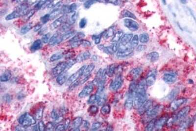 Immunohistochemistry-Paraffin: GPR161 Antibody [NLS331] - Anti-GPR161 antibody IHC of human Lung, Adenocarcinoma. Immunohistochemistry of formalin-fixed, paraffin-embedded tissue after heat-induced antigen retrieval.