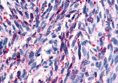 Immunohistochemistry-Paraffin: GPR161 Antibody [NLS333] - Human Brain, Glioblastoma. Immunohistochemistry of formalin-fixed, paraffin-embedded tissue after heat-induced antigen retrieval.