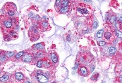Immunohistochemistry-Paraffin: GPR161 Antibody [NLS333] - Human Lung, Adenocarcinoma. Immunohistochemistry of formalin-fixed, paraffin-embedded tissue after heat-induced antigen retrieval.