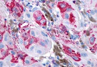 Immunohistochemistry-Paraffin: GPR161 Antibody [NLS333] - Human Skin, Melanoma. Immunohistochemistry of formalin-fixed, paraffin-embedded tissue after heat-induced antigen retrieval.