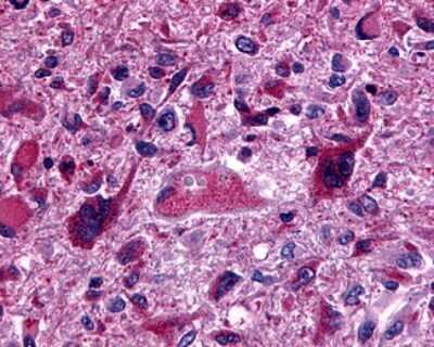 Immunohistochemistry-Paraffin: GPR162 Antibody [NLS1692] - Analysis of anti-GPR162 antibody with human brain, glioblastoma.