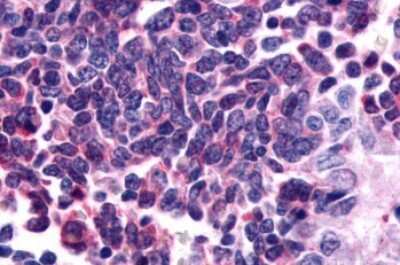 Immunohistochemistry-Paraffin: GPR162 Antibody [NLS1692] - Anti-GPR162 antibody IHC of human Lung, Small Cell Carcinoma. Immunohistochemistry of formalin-fixed, paraffin-embedded tissue after heat-induced antigen retrieval.