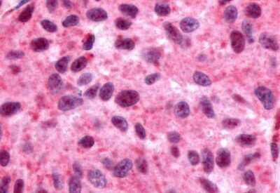 Immunohistochemistry-Paraffin: GPR162 Antibody [NLS1692] - Anti-GPR162 antibody IHC of human Skin, Melanoma. Immunohistochemistry of formalin-fixed, paraffin-embedded tissue after heat-induced antigen retrieval.