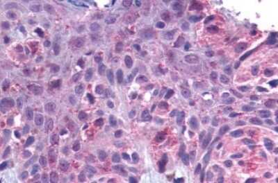 Immunohistochemistry-Paraffin: GPR162 Antibody [NLS1695] - Anti-GPR162 antibody IHC of human Skin, Melanoma. Immunohistochemistry of formalin-fixed, paraffin-embedded tissue after heat-induced antigen retrieval.
